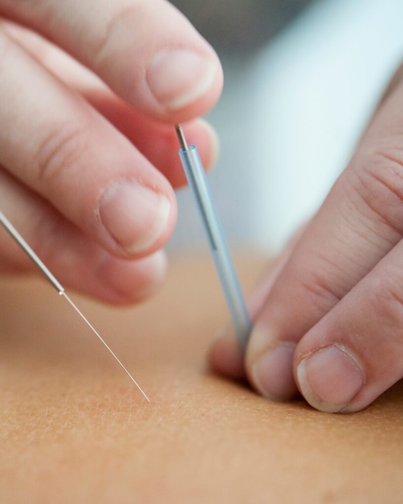 Acupuncture by Penny Rice, Licensed Acupuncturist